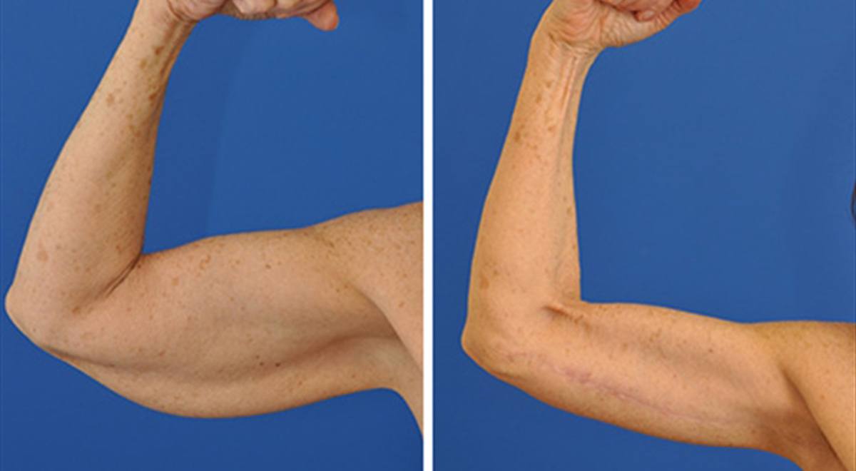 Before and after arm lift procedure