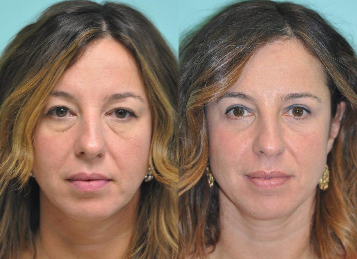 Before and after blepharoplasty procedure