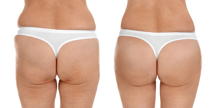 Before and after body lift procedure