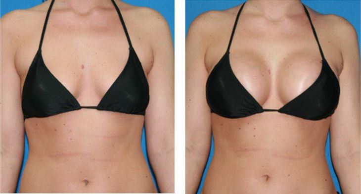 Before and after breast enlargement procedure