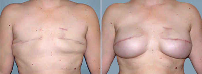 Before and after breast reconstruction procedure