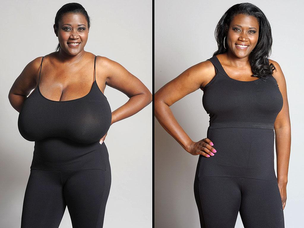 Before and after breast reduction procedure