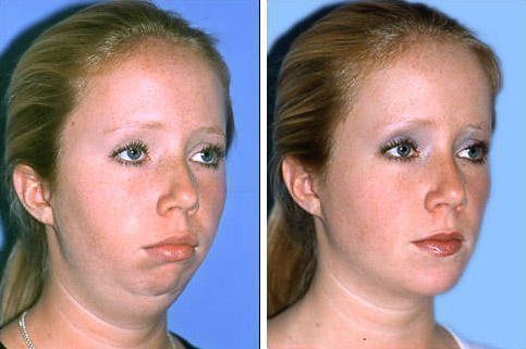 Before and after chin augmentation procedure