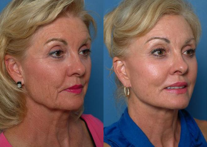 Before and after eyebrow lift procedure