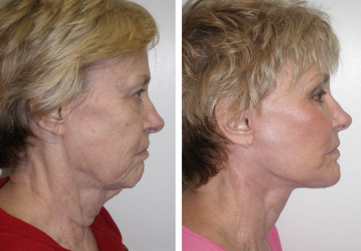 Before and after facelift procedure