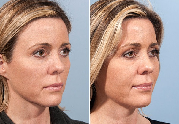 Before and after fat transfer procedure