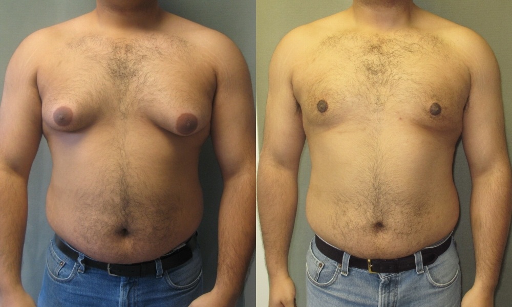 Male Breast Reduction procedure
