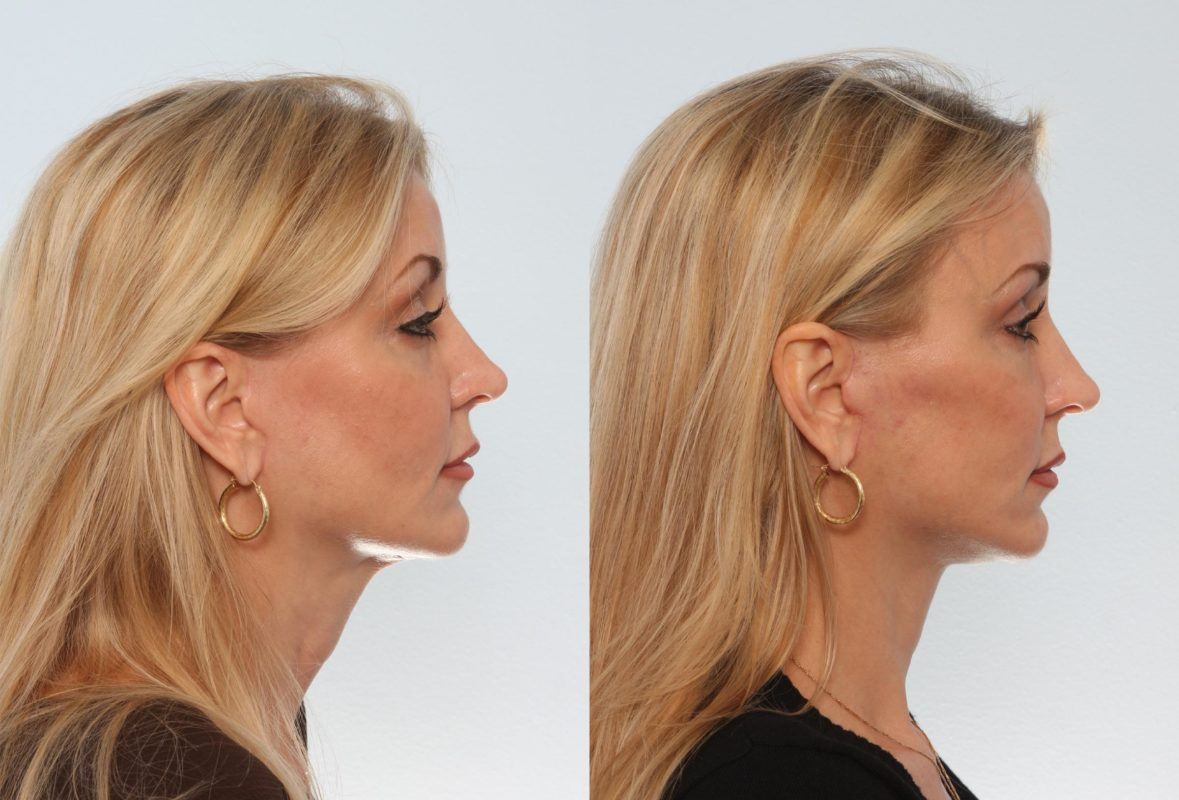 Before and after neck lift procedure