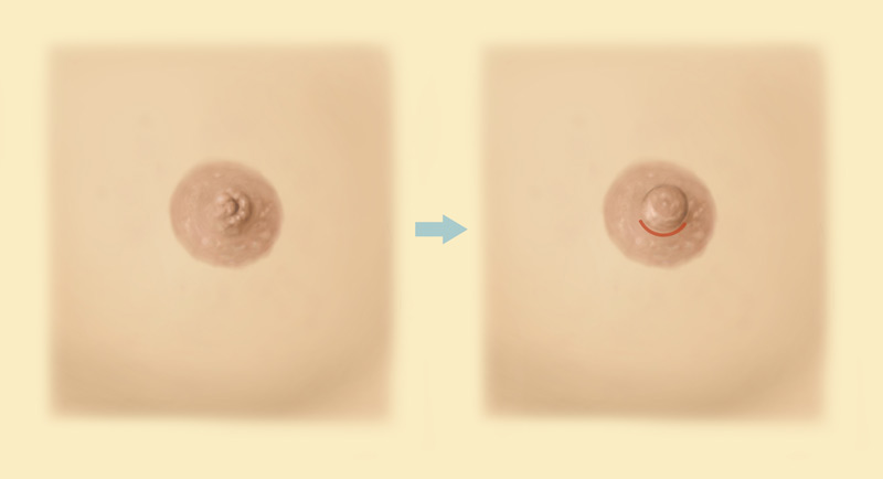 Nipple Surgery procedure