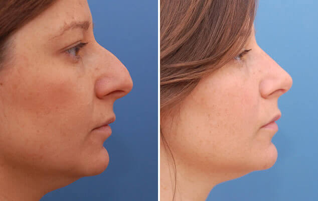 Before and after rhinoplasty procedure