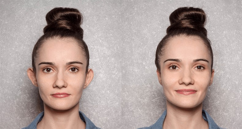 Before and after otoplasty procedure