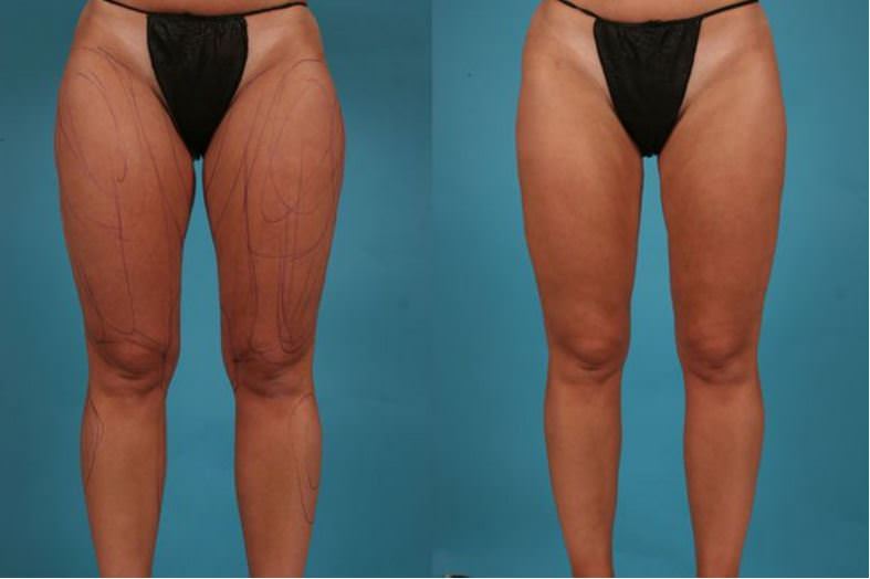 Before and after thigh lift procedure