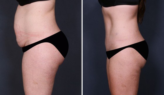 Before and after tummy tuck procedure