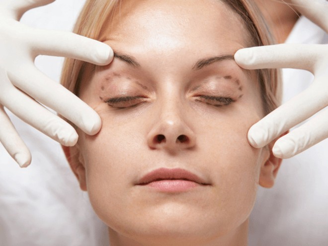Blepharoplasty procedure