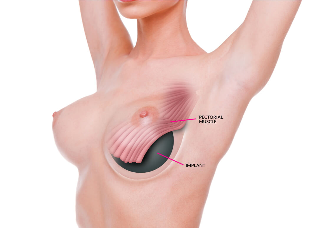 Breast Enlargement procedure