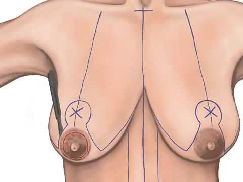 Breast Lift procedure