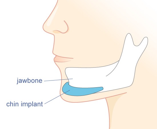 Chin Augmentation procedure