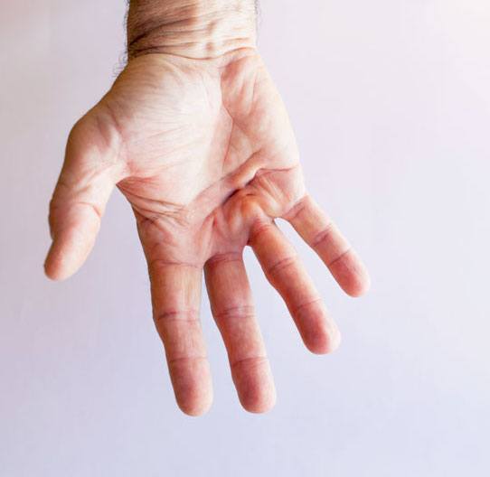 Dupuytren's contracture treatment result