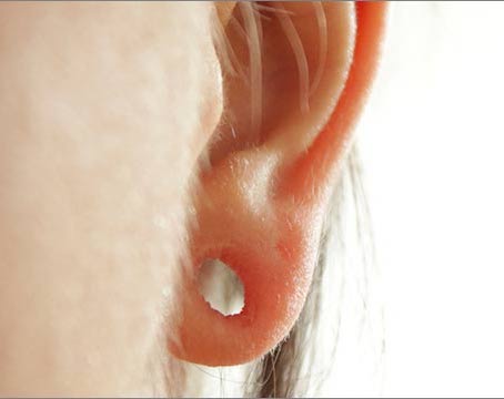Earlobe Surgery procedure