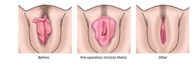 Labiaplasty procedure