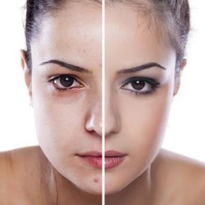 Laser Therapy procedure - Gallery image 4