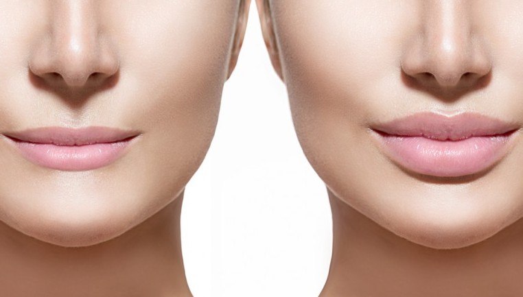 Facial Fillers procedure - Gallery image 3