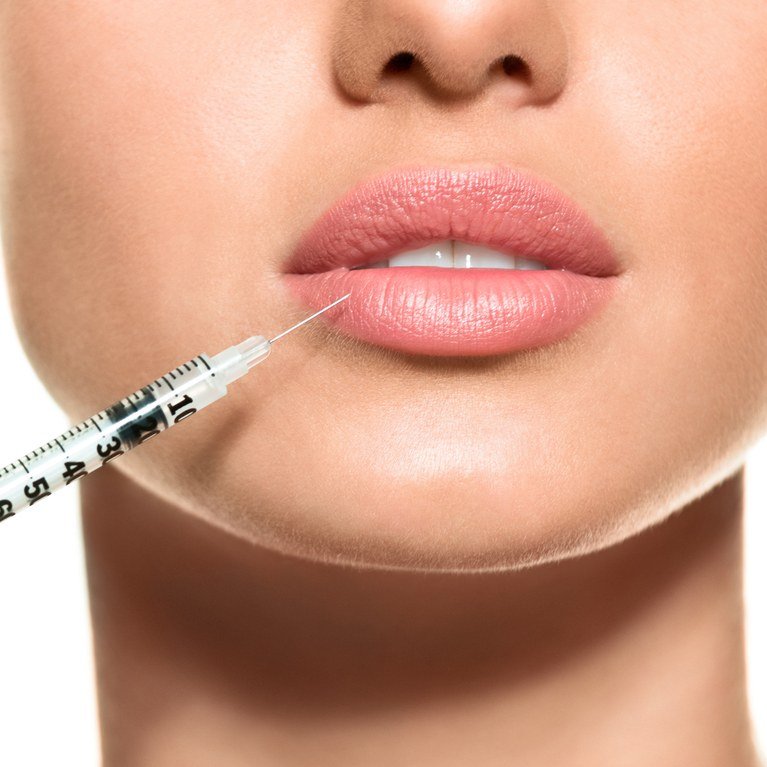Facial Fillers procedure - Gallery image 4
