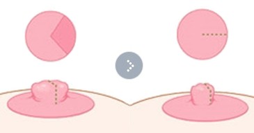 Nipple Surgery procedure