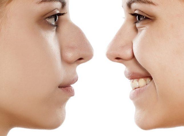 Nose Job (Rhinoplasty) procedure