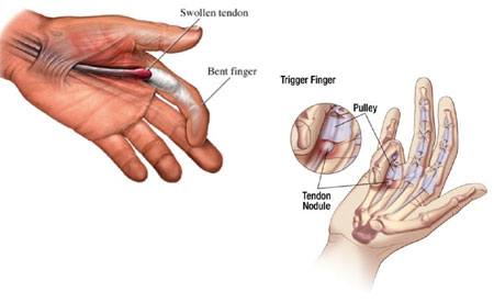 Trigger Finger procedure