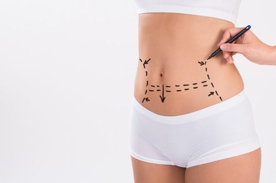 Tummy Tuck procedure